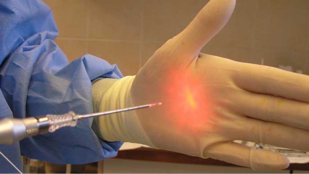 لیزر هموروئید؛ درمانی قطعی و فوری لیزر هموروئید؛ درمانی قطعی و فوری